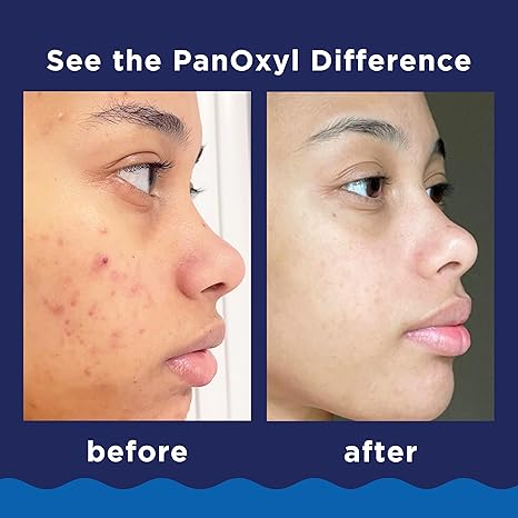 PanOxyl 10% Benzoyl Peroxide Acne Foaming Wash – Maximum Strength Face & Body Cleanser, 5.5 oz